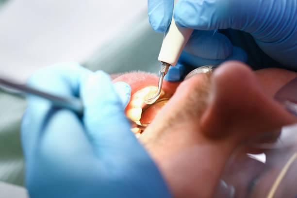 Best Emergency Dental Care for Sports Injuries in Untain Grove, MO