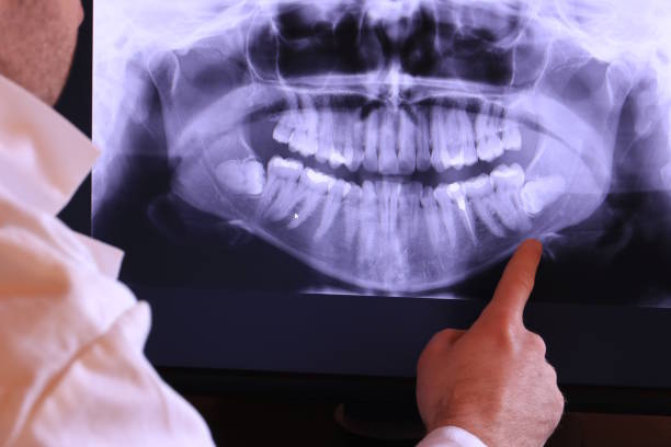 Best Emergency Wisdom Tooth Extraction in Untain Grove, MO